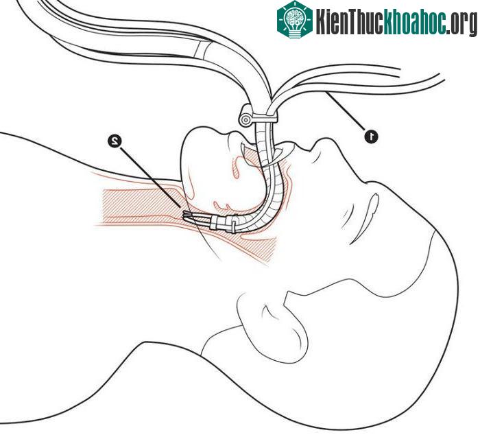 Robot Flex có thể được áp dụng cho nhiều ca phẫu thuật với các nhu cầu khác nhau.