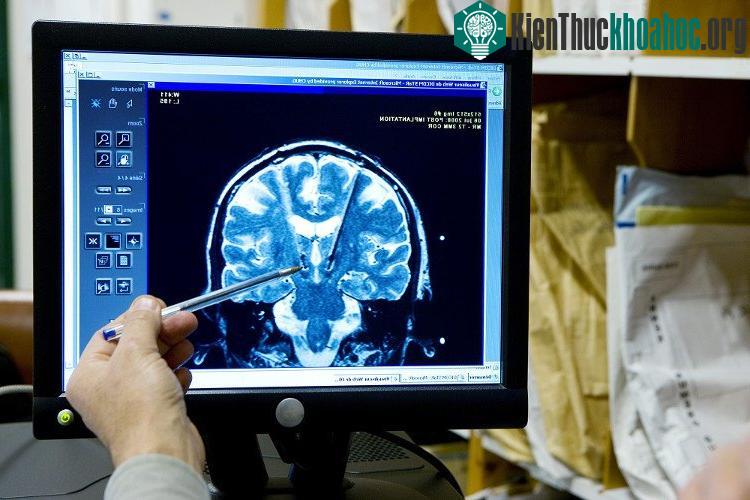 Bằng cách theo dõi hoạt động của não, phát minh mới có thể chuyển đổi suy nghĩ thành lời nói.