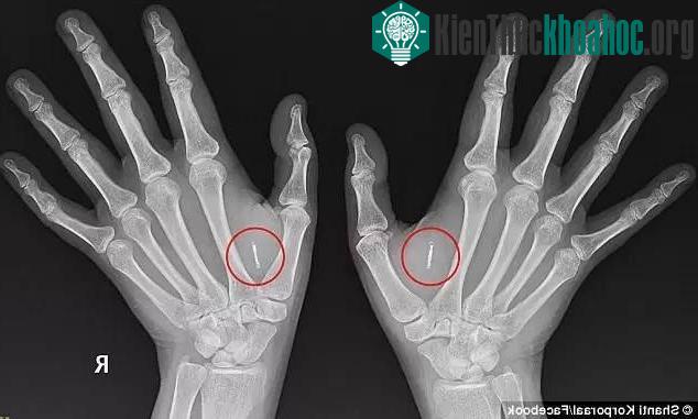 Vi mạch được cấy gần như không thể phát hiện vì nó chỉ bé như một hạt gạo.