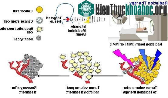 Điều trị ung thư bằng xạ trị.