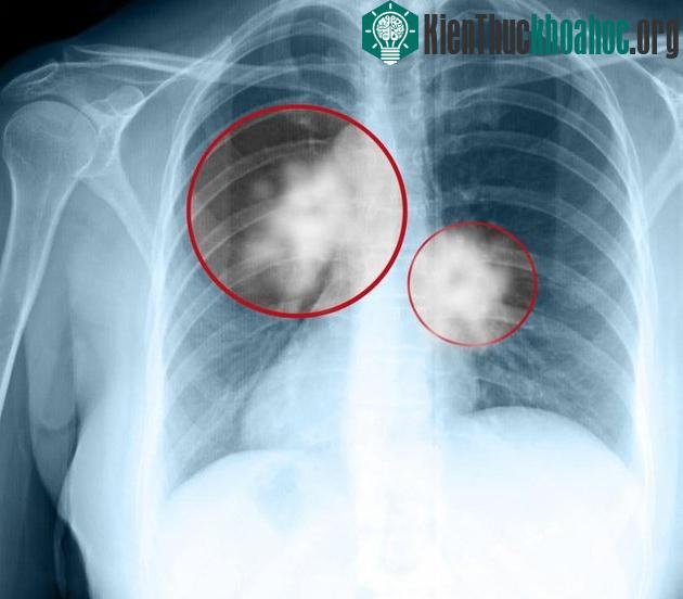 Cimavax không tấn công trực tiếp khối u mà tăng cường hệ miễn dịch cơ thể.