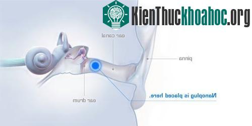 Vị trí đặt máy trợ thính Nanoplug trong tai. (Ảnh: Indiegogo)