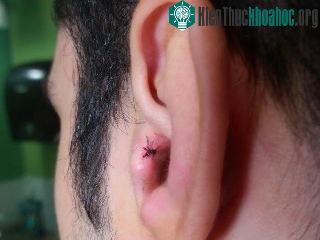 Vết khâu khi cấy một nam châm vào tai