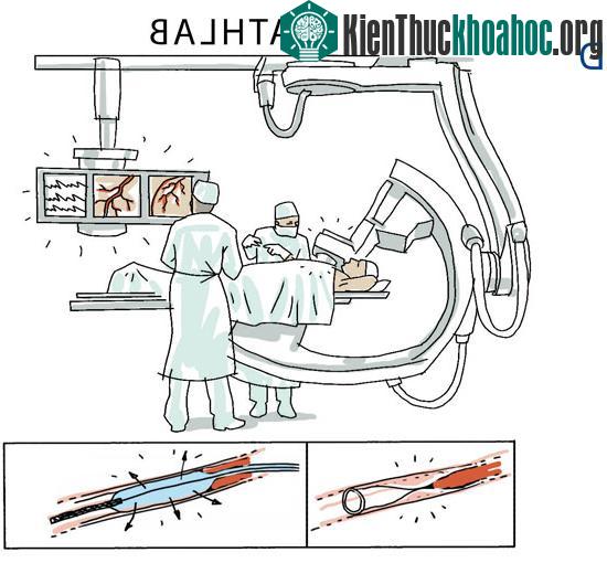 Trong những ca khẩn cấp như bệnh nhân bị suy tim, việc xét nghiệm tại chỗ sẽ giúp cho bác sĩ nhanh chóng chẩn đoán được tình trạng bệnh nhân và đưa ra phương án xử lý phú hợp. Quyết định mở động mạ...