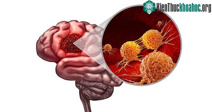 Hình ảnh mô phỏng u nguyên bào thần kinh đệm.