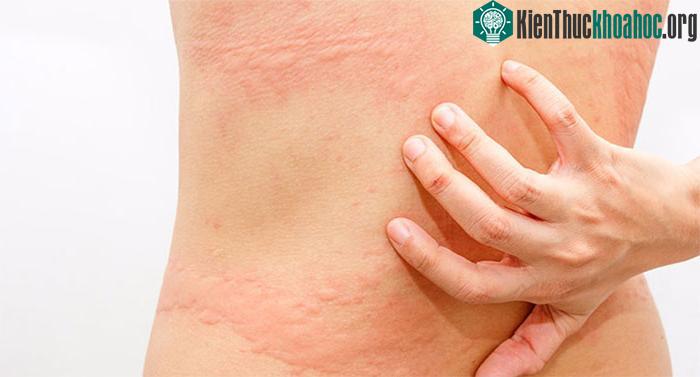 Nổi mề đay thành từng mảng lớn và sưng tấy đỏ.