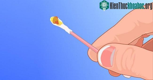 Tình trạng ráy tai có liên quan đến một số bệnh lý của tai.
