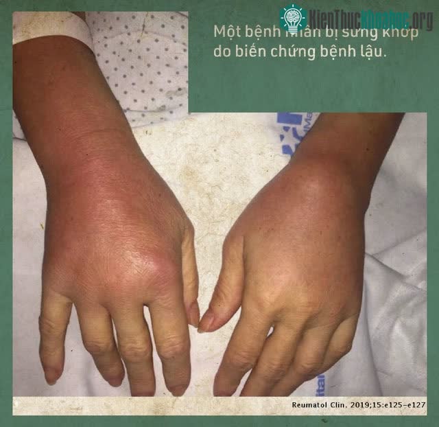 Bệnh nhân sưng khớp do biến chứng bệnh lậu