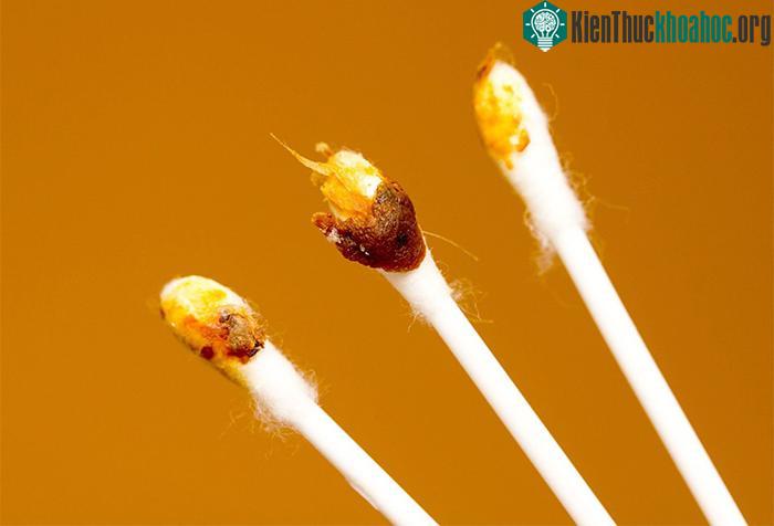 Màu sắc bất thường của ráy tai báo hiệu một số bệnh lý bất thường.