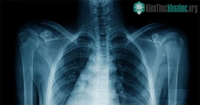 AI có thể dự đoán chính xác về chủng tộc của bệnh nhân chỉ dựa trên tấm phim chụp X-quang