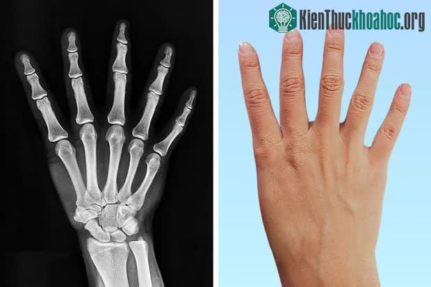 Có ngón tay cái với 3 đốt hoặc có ngón tay thừa