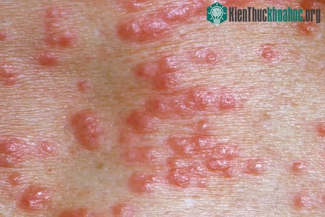 Một người bị ghẻ nước lần đầu tiên có thể mất 4-6 tuần để da xuất hiện triệu chứng.