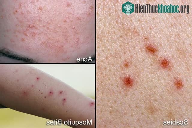 Ghẻ nước dễ bị nhầm lẫn với mụn trứng cá hay muỗi đốt...