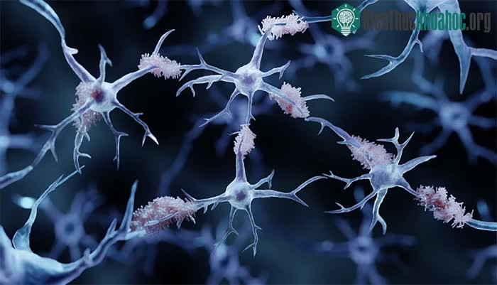 &nbsp;Bệnh Alzheimer là nguyên nhân phổ biến nhất của sự sa sút trí tuệ.