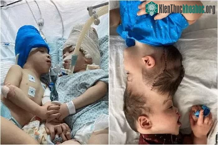 Đây là một trong những quá trình tách đầu phức tạp nhất từng được thực hiện.