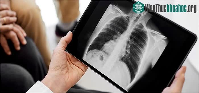 Phát hiện mới về nguyên nhân gây ung thư phổi ảnh 1