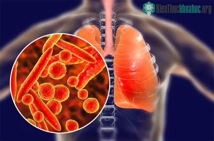 Bệnh nhiễm trùng phổi kháng thuốc rất khó điều trị.
