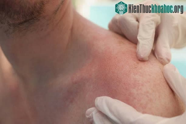 Người bị dị ứng thịt đỏ nên tránh hoàn toàn bít tết.