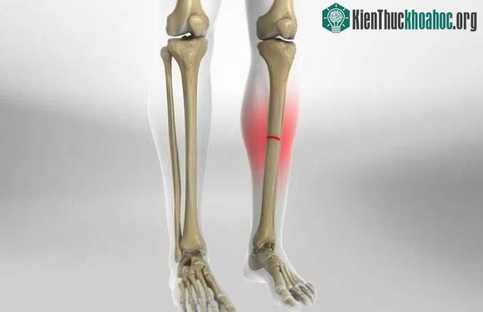 Phát hiện mới sẽ giúp việc điều trị chấn thương xương chính xác hơn.
