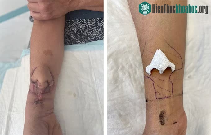 Hình ảnh chiếc mũi nhân tạo được nuôi trên cẳng tay bệnh nhân.