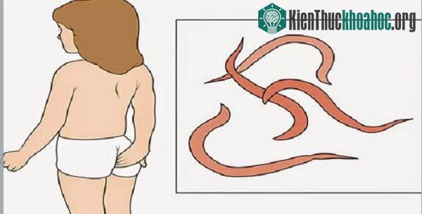 &nbsp;Giun kim thường tụ tập ở hậu môn của trẻ, gây ngứa ngáy khó chịu.