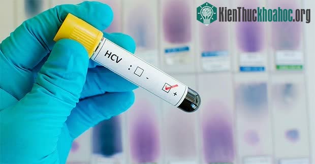 Viêm gan C ảnh hưởng đến 71 triệu người trên thế giới.