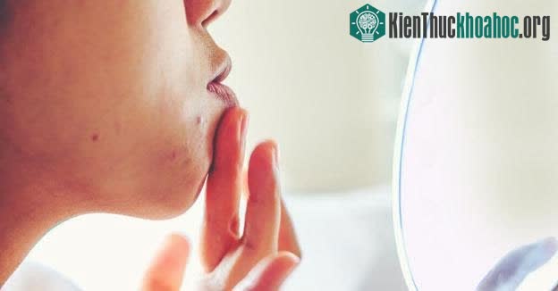 Uống sữa có gây ra mụn không? ảnh 2