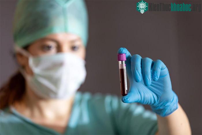 Nhóm máu A có nguy cơ đột quỵ sớm cao hơn 18% so với người có nhóm máu khác.