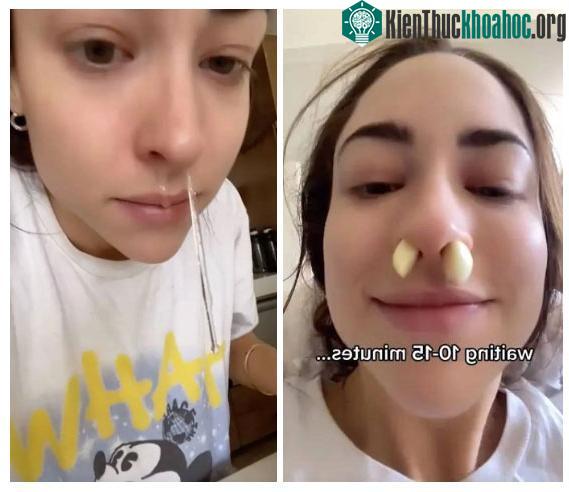 Người phụ nữ này đã nhét những viên tỏi đã bóc vỏ vào mũi, đợi 10 phút mới bỏ ra.