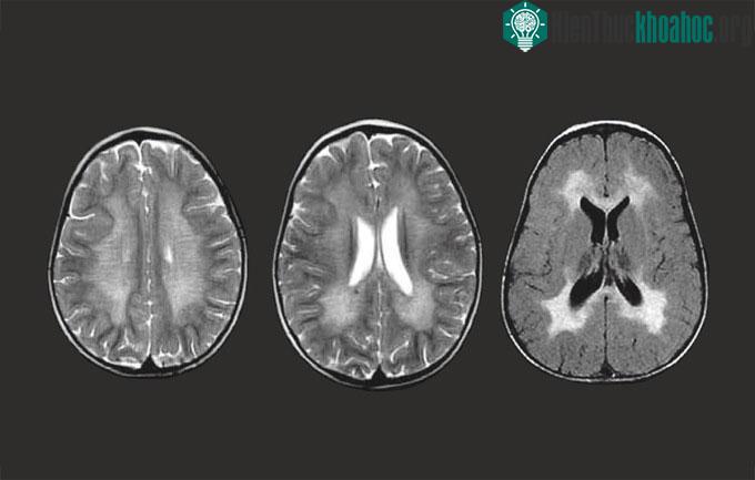 Não bộ của người mắc chứng loạn dưỡng chất chuyển sắc.