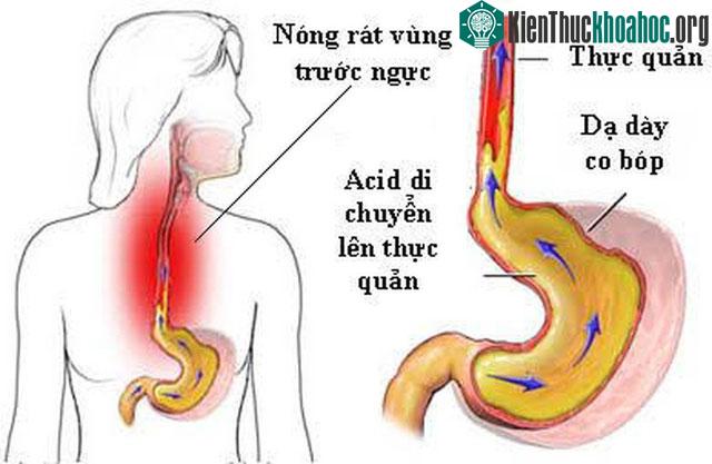 Hình ảnh trào ngược dạ dày - thực quản.