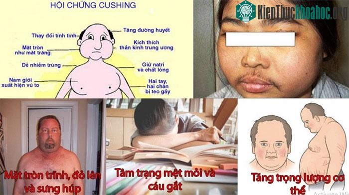 Các tác dụng phụ nguy hiểm do corticoid gây ra
