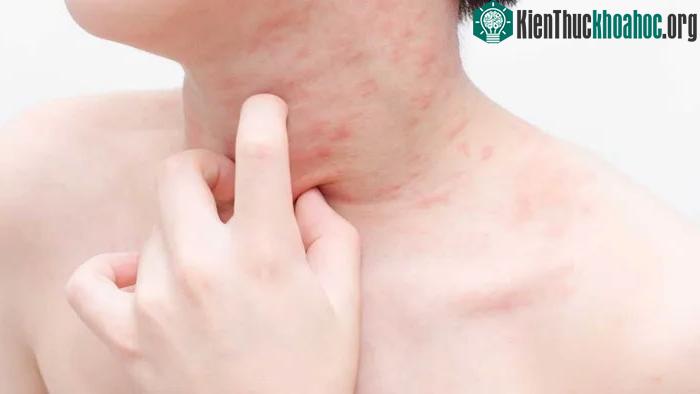Sốc phản vệ do ăn trứng kiến: Những điều cần biết để bảo vệ sức khoẻ ảnh 1