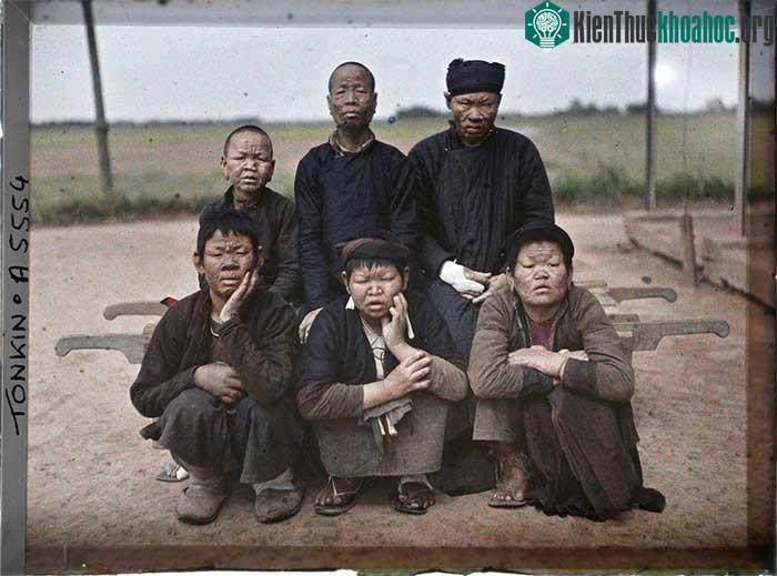 Các bệnh nhân trong trại cùi ở Yên Duyên, nay thuộc phường Yên Sở, quận Hoàng Mai, Hà Nội.