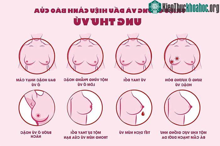 Ung thư vú thường xuất hiện với triệu chứng là có u cục ở tuyến vú.