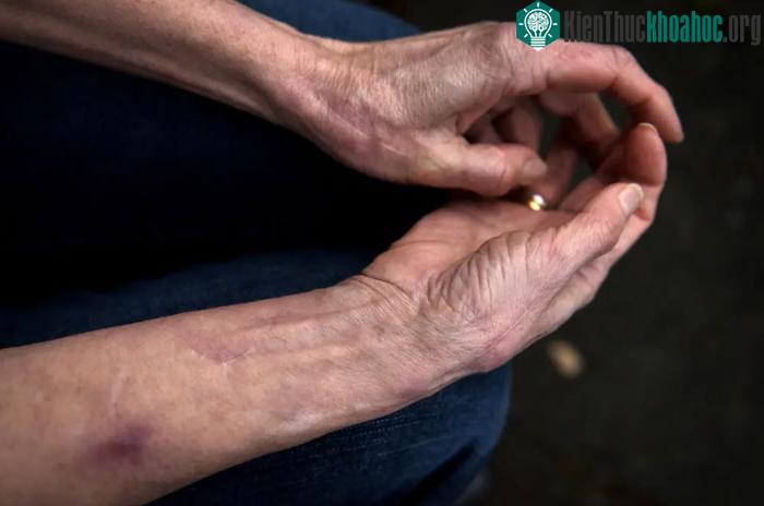 Người phụ nữ 75 tuổi chưa từng cảm thấy đau hay sợ hãi nhờ mang gene hiếm ảnh 2