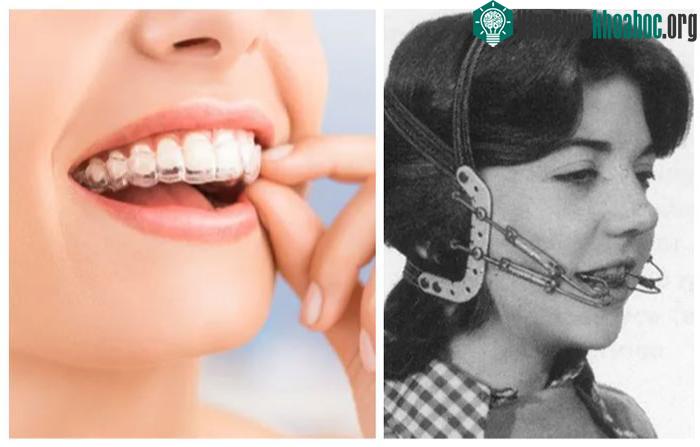 Niềng răng xưa và nay đã có sự cải tiến khó có thể nhận ra