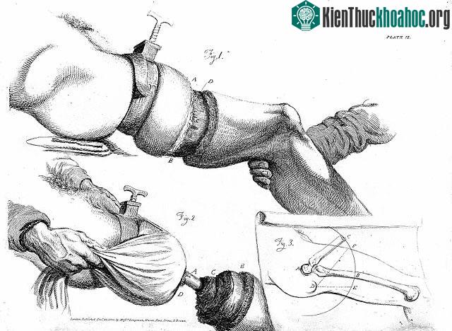 Lịch sử thăng trầm của thuốc giảm đau và gây mê ảnh 0