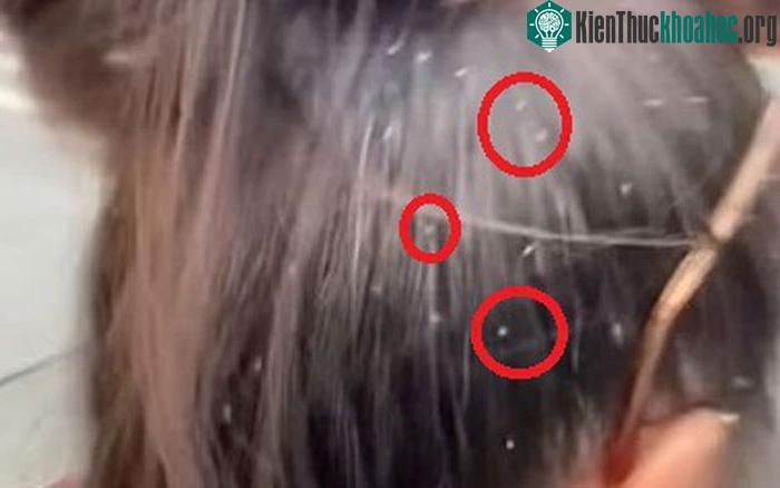 Những con rệp vừng bám vào tóc người đi đường.