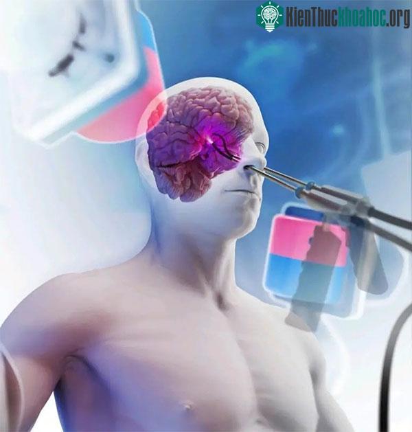 Lần đầu tiên sử dụng hai robot mềm điều khiển từ tính cho ca phẫu thuật phía trước não.