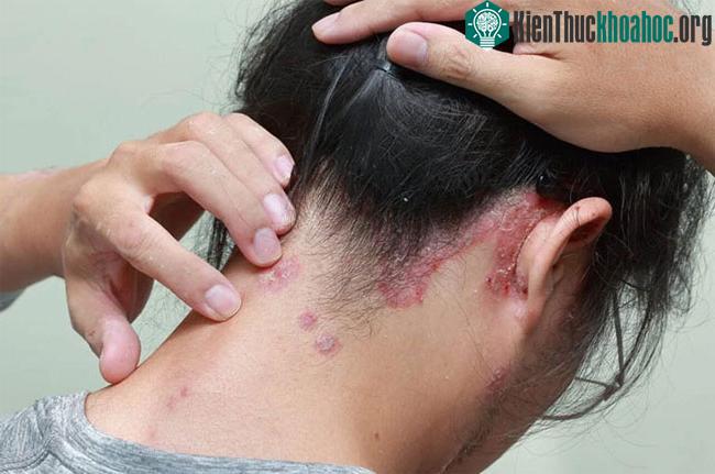 Thường xuyên đội mũ bảo hiểm ẩm có thể gây ra tình trạng ngứa đầu, rụng tóc nhiều...