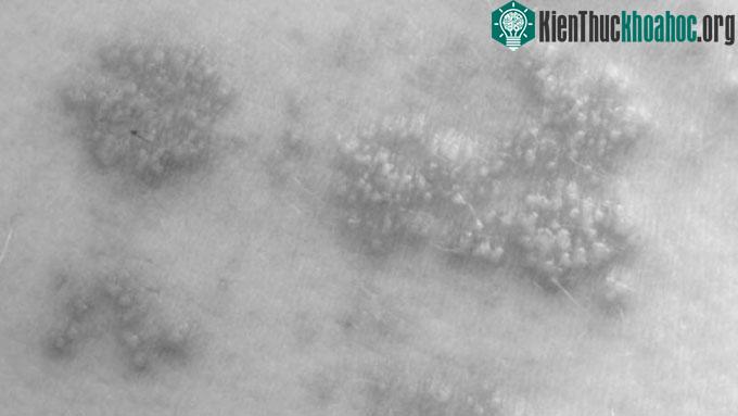 Tổn thương u nhú do HPV.