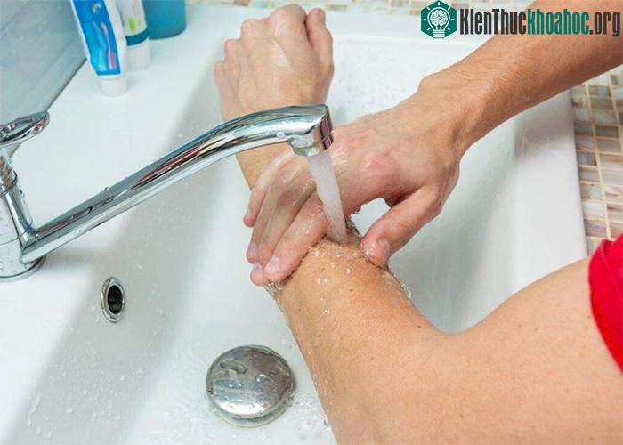 Sơ cứu vết bỏng để giảm thiểu thiệt hại và thúc đẩy quá trình lành vết thương.