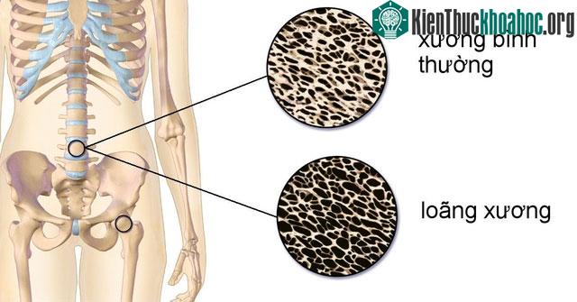 Top 4 loại thực phẩm là “Vua ăn cắp canxi”, khiến nhiều người ngã nhẹ đã gãy xương ảnh 0