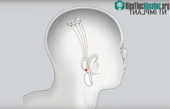 Con chip sẽ nằm phía sau tai và có các dây dẫn nối với các điện cực tiếp xúc với não.