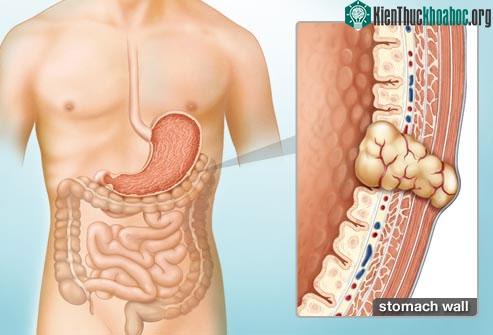 GIST được nghi ngờ và phát hiện dựa trên các triệu chứng như thiếu máu, đau bụng...