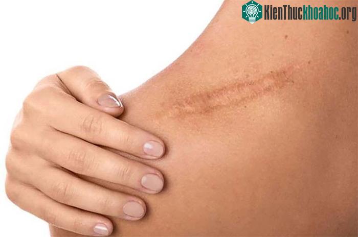 Sự hình thành sẹo phụ thuộc vào mức độ lành thương của cơ thể.