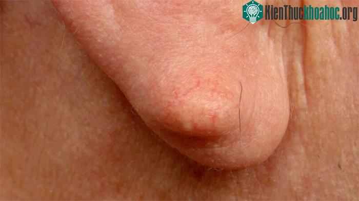 U cục sau tai đơn giản có thể là do mụn trứng cá