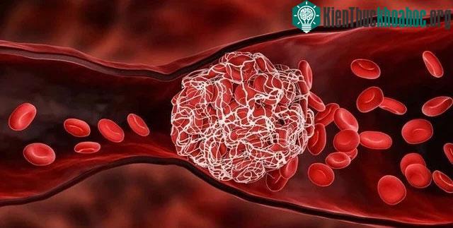 Thời tiết quá lạnh sẽ tác động đến hoạt động của mạch máu, dẫn đến nguy cơ đột quỵ.
