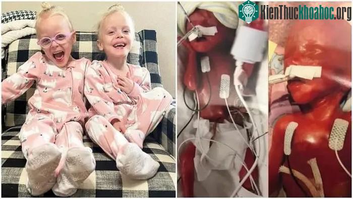 Keeley và Kambry Ewoldt chào đời khi mới hơn 22 tuần tuổi và sống sót thần kỳ.